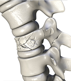 교통사고 후유증, 스포츠 손상