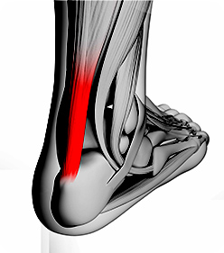 족저근막염, 아킬레스건염