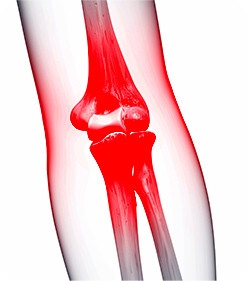 테니스엘보, 골프엘보